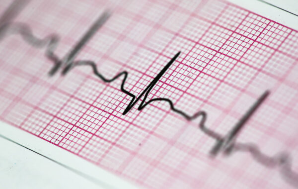 EKG elektronisches Kardiogramm